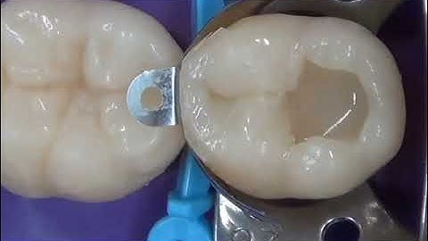 Trám Răng Composite