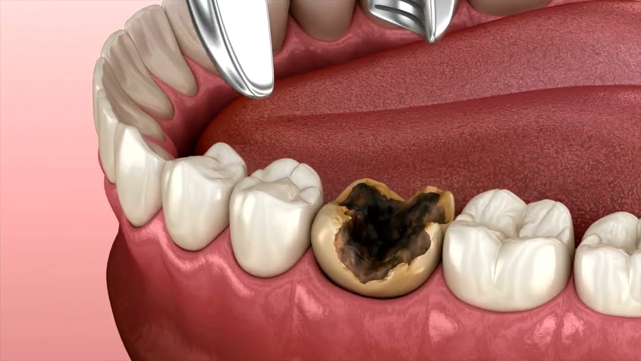 5 Simple Hacks to Quickly Ease Severe Tooth Pain