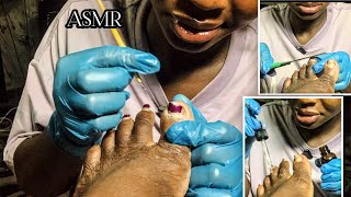 ASMR ✨Deep Ingrown Toenail Extraction ASMR 👣 | Super Relaxing Foot Treatment😉🥰