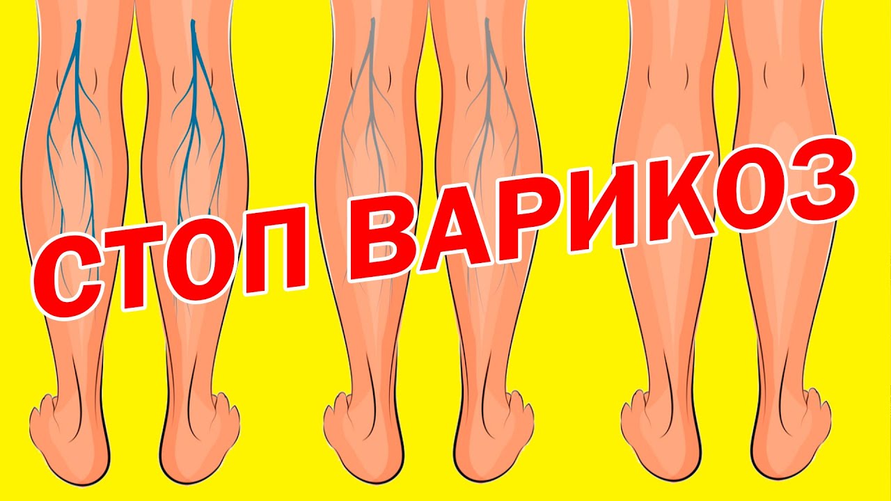 Упражнения для укрепления вен