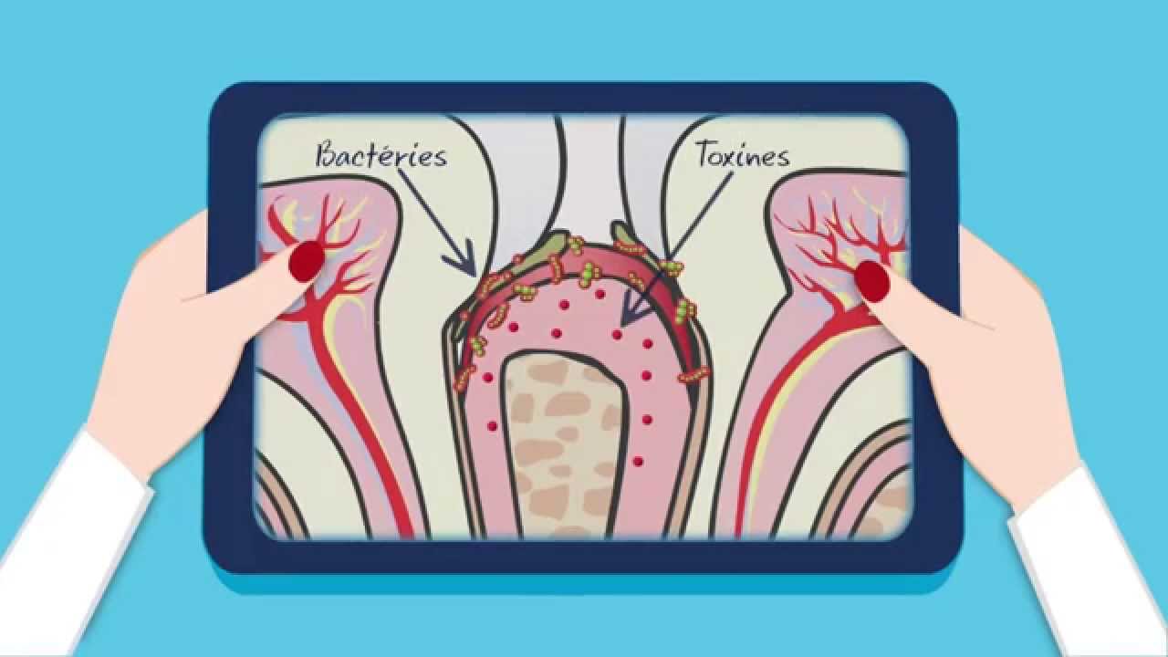 Qu'est-ce que la gingivite et la parodontite ?