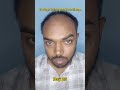 Day 25 | 180 days hair regrowth challenge #manmatters #lifeisbutadream #hairstyle