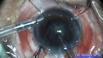 Cataract surgery in a case of phacodonesis using iris hooks to support the capsular bag