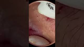 Relaxing ?? acne pimple blackhead pimplepop pimples satisfying satisfyingvideo viral  ID V