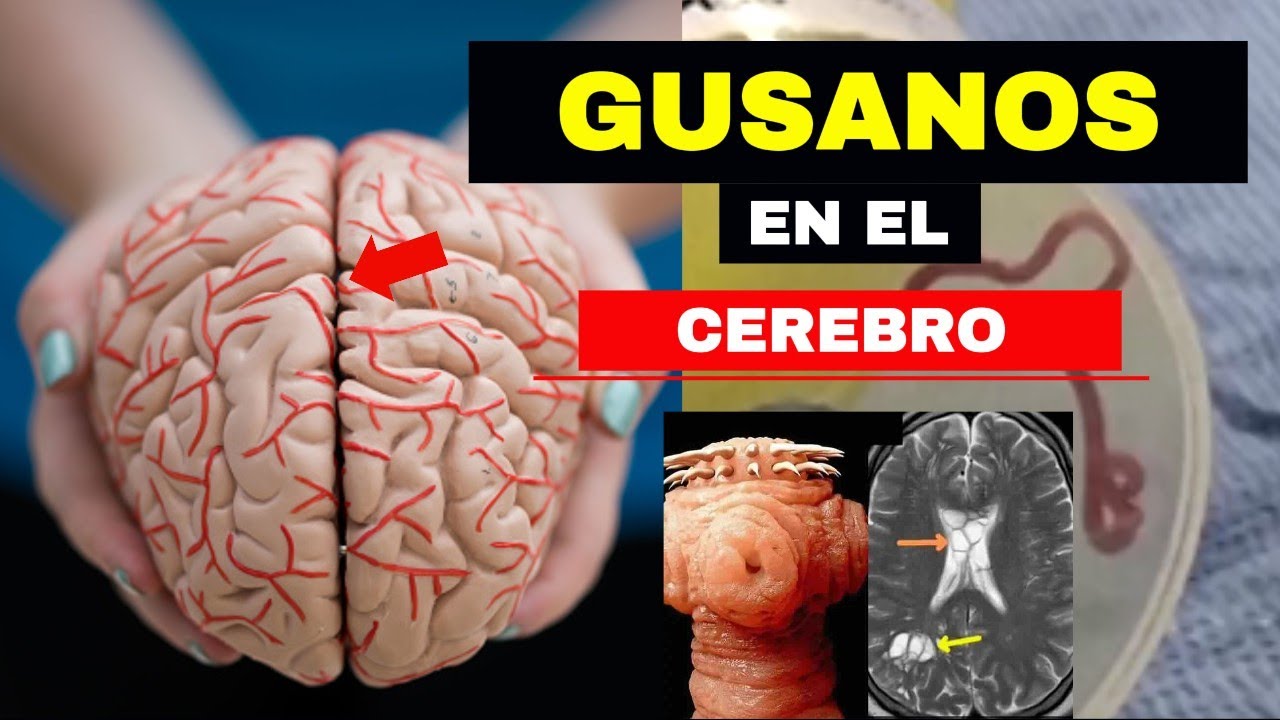 NEUROCISTICERCOSIS: CUANDO LA SOLITARIA INVADE EL CEREBRO