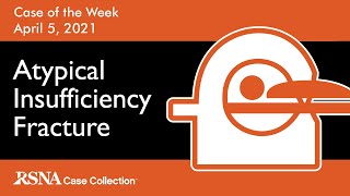 Case of the Week Atypical Insufficiency Fracture