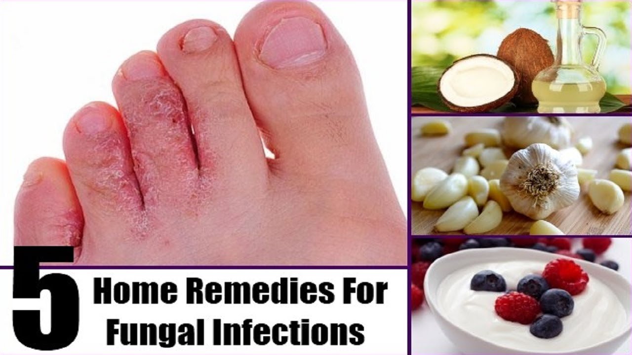 5 Ways You Can Treat Fungal Infections At Home By Top 5 Youtube