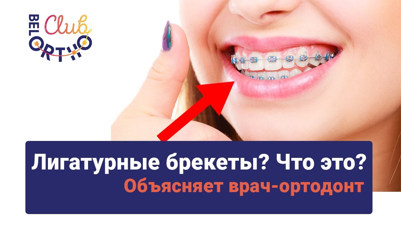 Что такое лигатурные брекеты? Объясняет врач-ортодонт | БелОртоКлуб ...