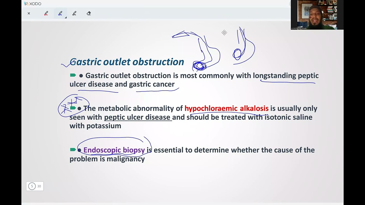 Gastric outlet obstruction