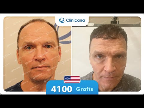 Jan’s hair transplant