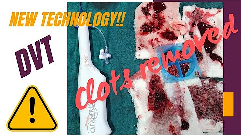 DVT clot removal new technique