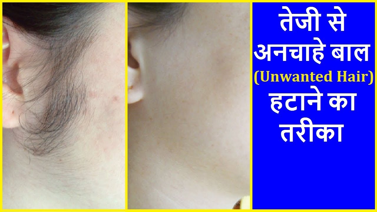 अनचाहे बालों से हमेशा हमेशा के लिए छुटकारा पाएं Permanent Hair Removal at Home in Hindi YouTube