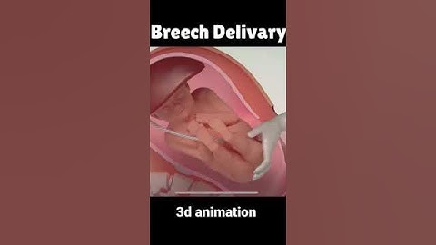 Breech Delivery 3D animation #shortvideo #shorts