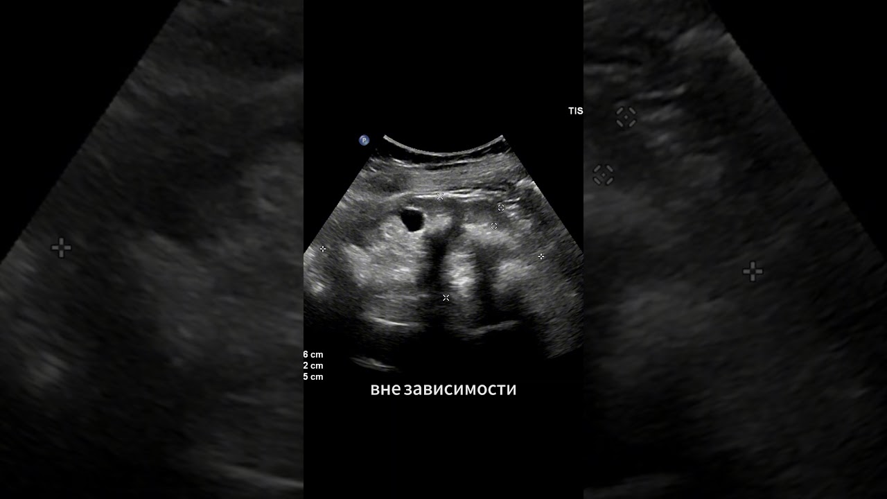 Медуллярный нефрокальциноз.