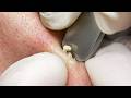 Deep Blackhead &amp; Cystic Acne Extraction: The ULTIMATE Guide to Clear and Healthy Skin!