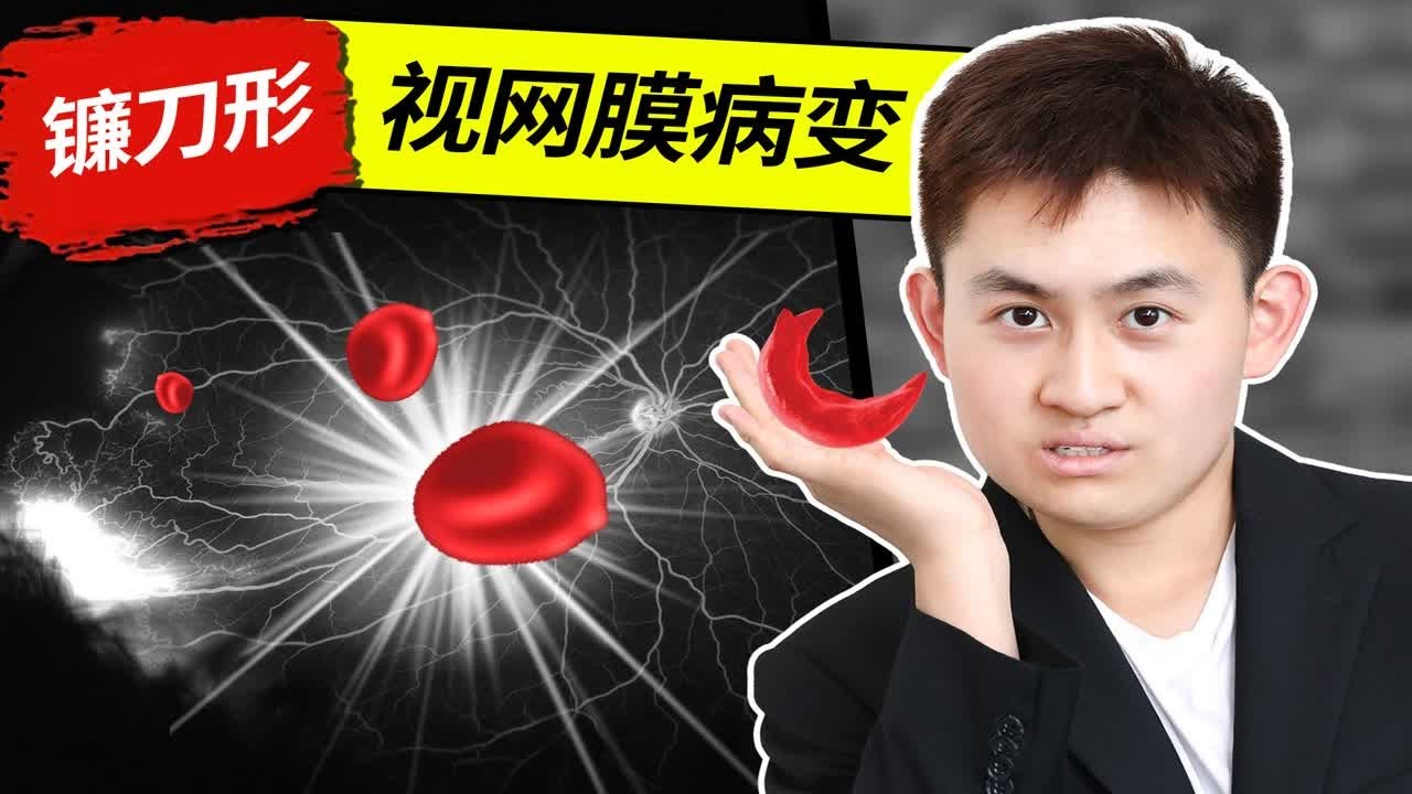 眼底病 - 镰刀形细胞贫血症是什么？血液里的“镰刀”是如何夺走人们的光明的？【高中生物来了】