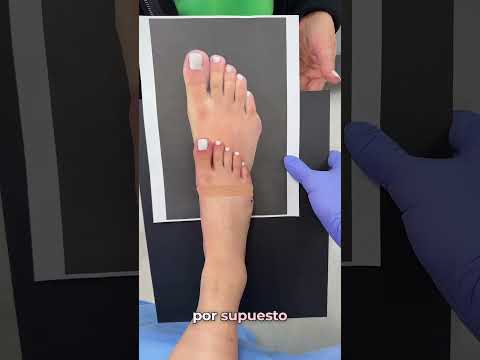 LETS HEAD INTO THE OPERATING ROOM AND TALK ABOUT THE TAILOR’S BUNION💫🦶🏼