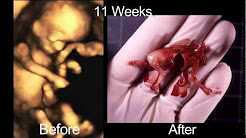 photo of 5 week old fetus