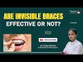 Are Invisible Braces Effective or Not? Invisible Aligners or Braces Treatment In Agra, UP-Dr Pooja