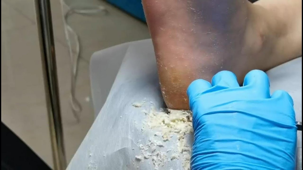 Pedicure Tutorial Friday Cheese is coming. Dead skin removal and