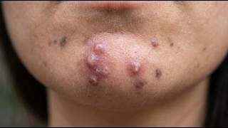 Loan Nguyen Acne Treatment 8kk