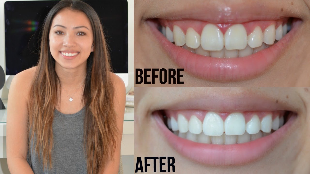 How To Whiten Your Teeth at Home
