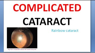 Ophthalmology Complicated Cataract Rainbow Drug Induced Steroid posterior subcapsular cortical