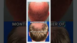 Hair Loss Treatment Before a Transplant | Why Medical Therapy Comes First - Austin, Texas
