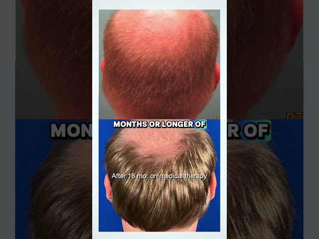 Hair Loss Treatment Before a Transplant | Why Medical Therapy Comes First - Austin, Texas