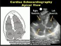 Порядок выполнения: ультразвуковое исследование сердца — апикальная проекция