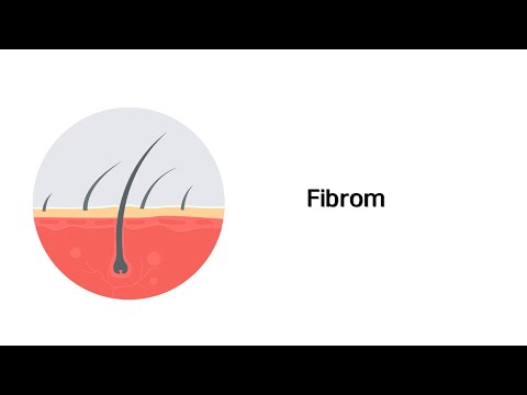 Video: Fibrom - Ursachen Und Symptome Von Fibrom, Diagnose, Behandlung Und Prävention