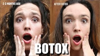 Botox in Bali (Before and After)