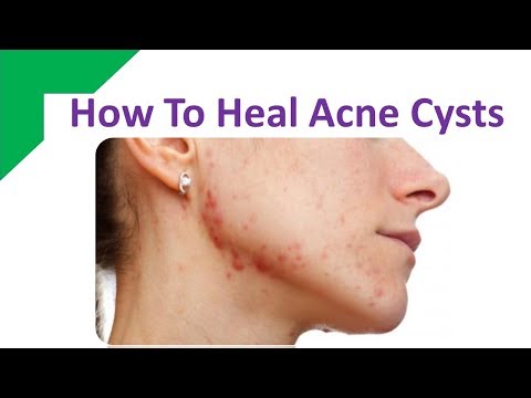 How To Heal Acne Cysts With Aspirin