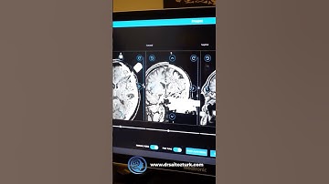 All stages of Deep Brain Stimulation (DBS) Surgery for the treatment of Parkinson’s Disease