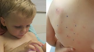 SHELLFISH ALLERGY RESULTS - YEARLY SKIN PRICK TEST