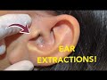 Blackhead new this week how to remove blackheads from nose|ear and nose pimple and blackhead removal