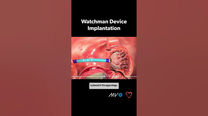 Watchman Implant Procedure 🫀 for #afib related #stroke