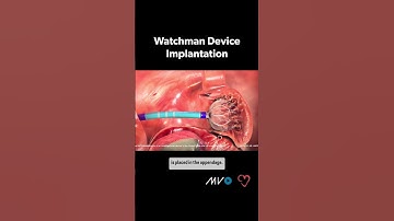 Watchman Implant Procedure 🫀 for #afib related #stroke