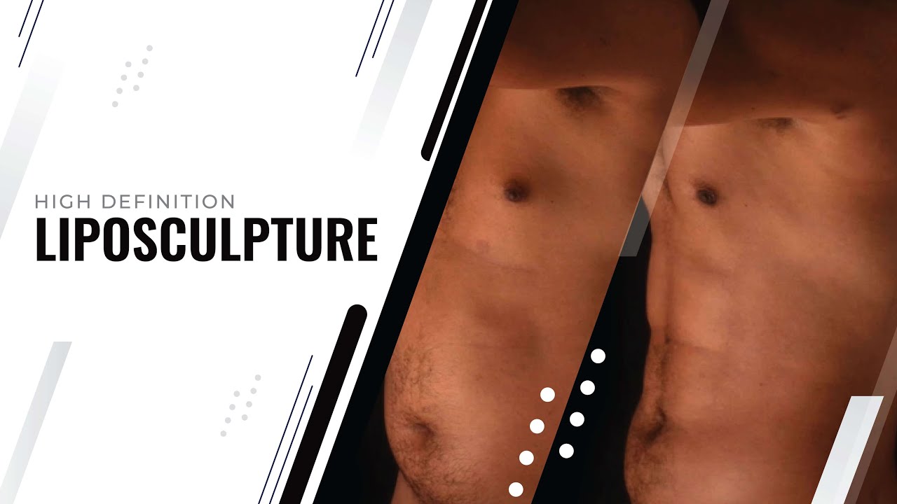 Dr Emer High Definition Liposculpture YouTube