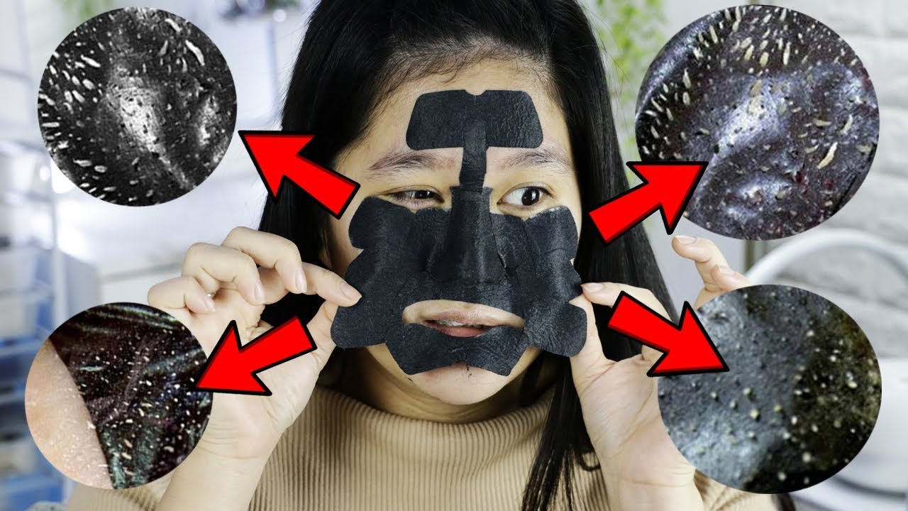 best blackhead removal ever