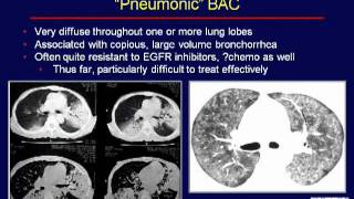 Gracecast-009Lung-Cancerthe Abcs Of Bac