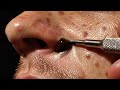 Satisfying Deep Pore Cleaning with Blackhead Vacuum Tool