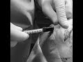 Micro lipostructure des paupières : rajeunir le regard | Dr Hayot