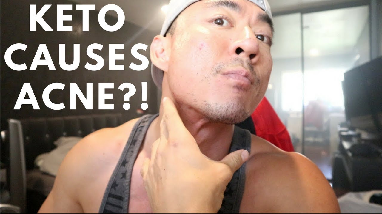 Keto Cut Ep 13 Keto Causes Acne? Peak Week YouTube