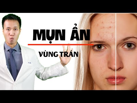 Cách Trị Mụn Ở Trán - Mụn ẩn ở Trán - Sai lầm nào khiến Skinacare dù nỗ lực cũng KHÔNG cải thiện| Dr Hiếu