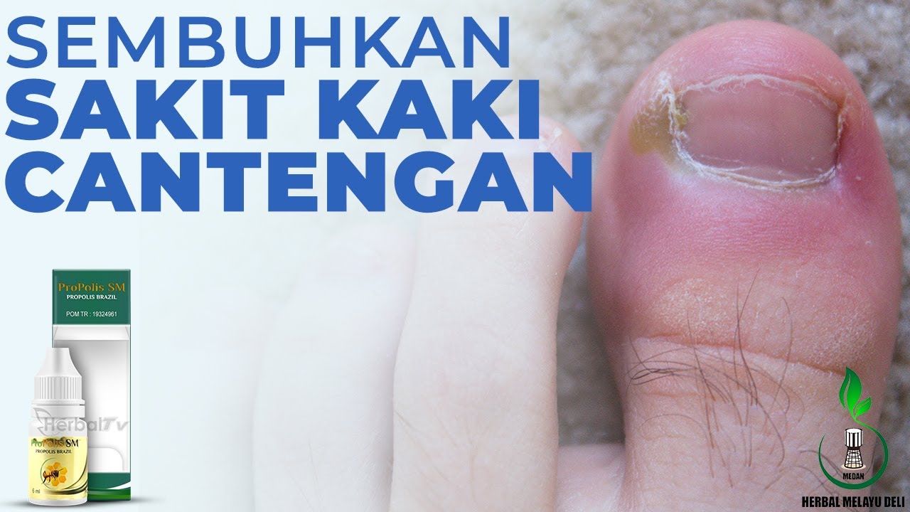 Penyebab dan Tips Mengatasi Cantengan - Propolis SM Untuk Cantengan