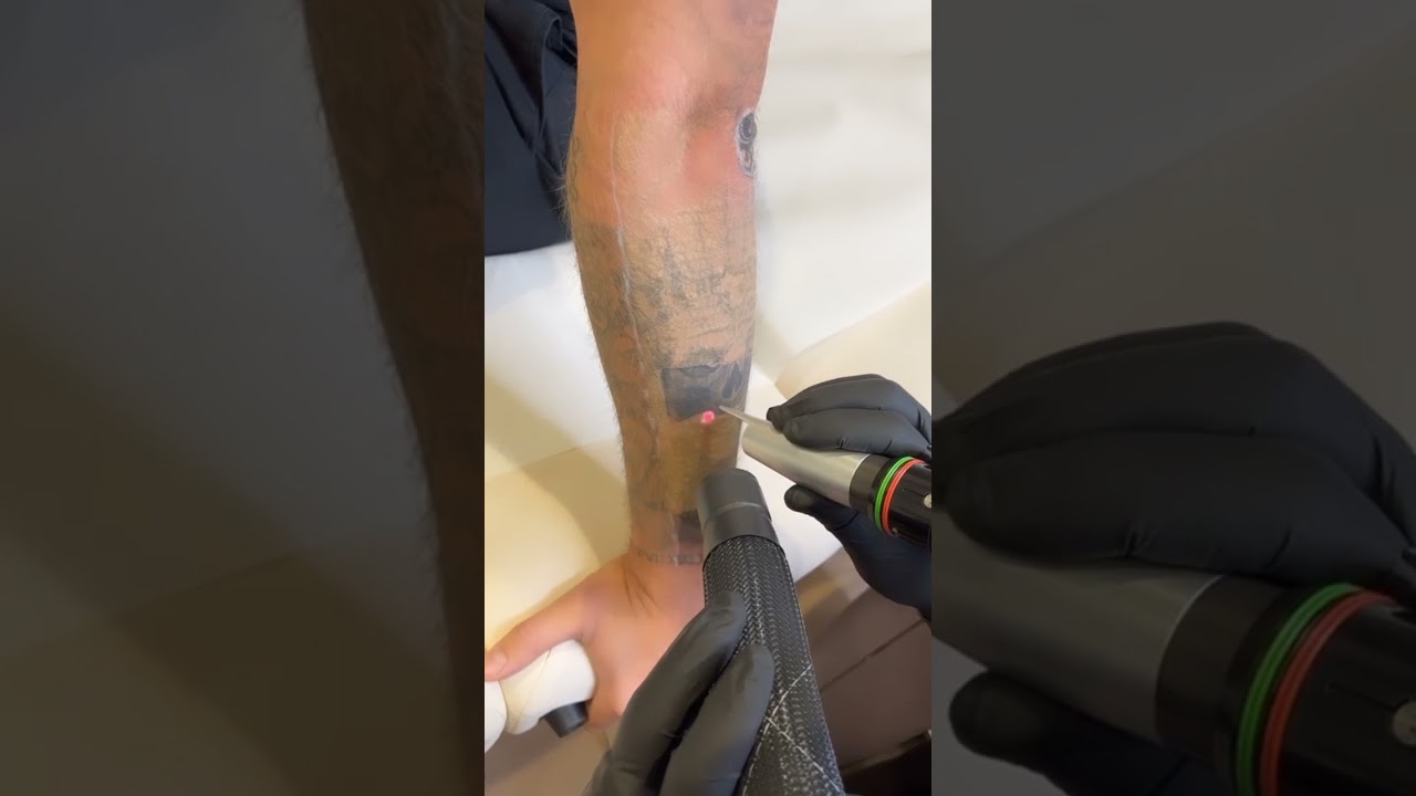 Laser tattoo removal on Black wrist tattoo vip Tattoo Art