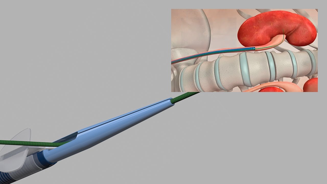 Acesso Ureteral com Flexor® Parallel™ Cook Medical YouTube
