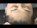 안티에이징 - 이마눈썹거상술 (2) Brow and Forehead  Lift