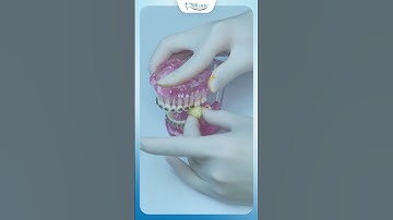 Niềng Răng Ăn Gì | Nha Khoa Minh Châu